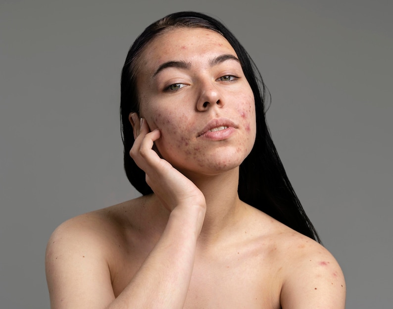 Peut inclure: Portrait rapproch&eacute; d'une personne pr&eacute;sentant de l'acn&eacute; sur le visage et les &eacute;paules. Elle a de longs cheveux noirs et regarde directement la cam&eacute;ra.