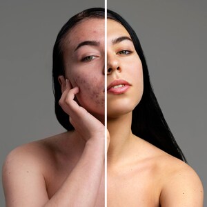 Peut inclure: Une image avant-apr&egrave;s d'un visage, montrant la diff&eacute;rence de clart&eacute; de la peau. Le c&ocirc;t&eacute; gauche du visage montre de l'acn&eacute; et des imperfections, tandis que le c&ocirc;t&eacute; droit du visage appara&icirc;t clair et lisse.