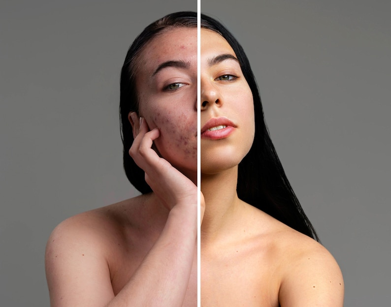 Peut inclure: Une image avant-apr&egrave;s d'un visage, montrant la diff&eacute;rence de clart&eacute; de la peau. Le c&ocirc;t&eacute; gauche du visage montre de l'acn&eacute; et des imperfections, tandis que le c&ocirc;t&eacute; droit du visage appara&icirc;t clair et lisse.