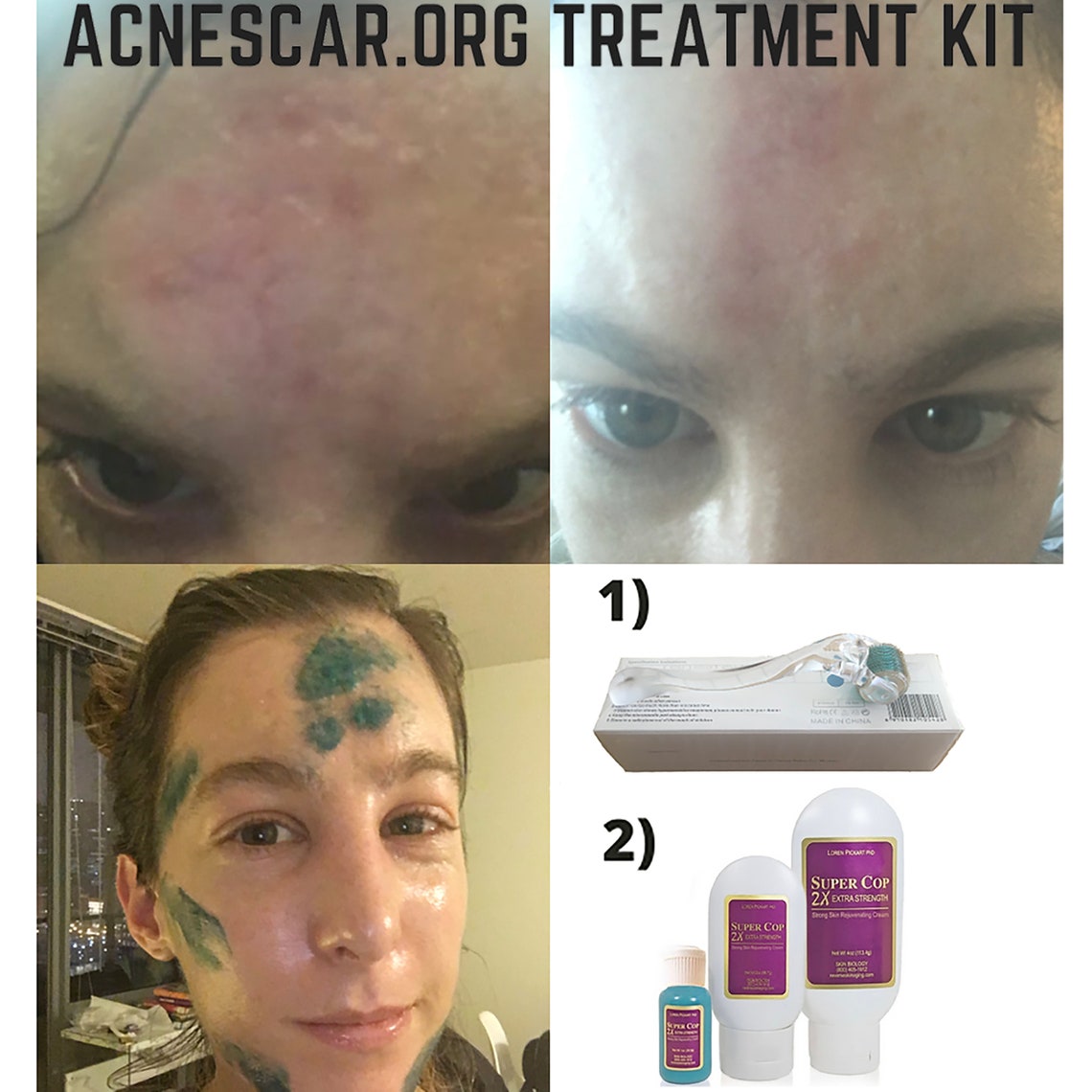 Acne Scars Indented Atrophic Rolling Pitted Deep, Heal Remove Treat Get