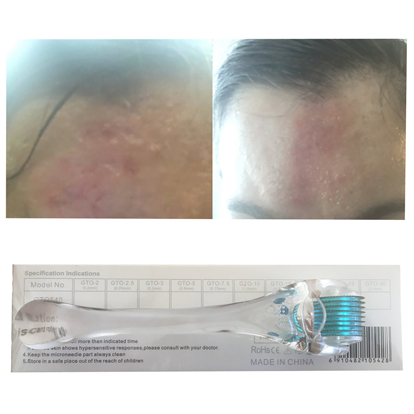 Derma Roller for Acne Scars Microneedling for Acne Scarring Etsy