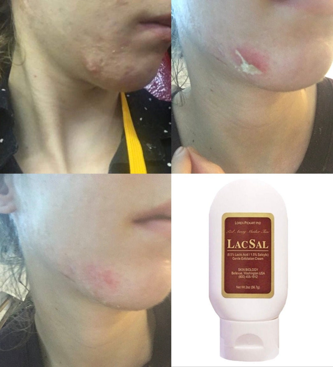 Lactic Acid Exfoliation Lotion, Exfoliation Cream & Salicylic Acid