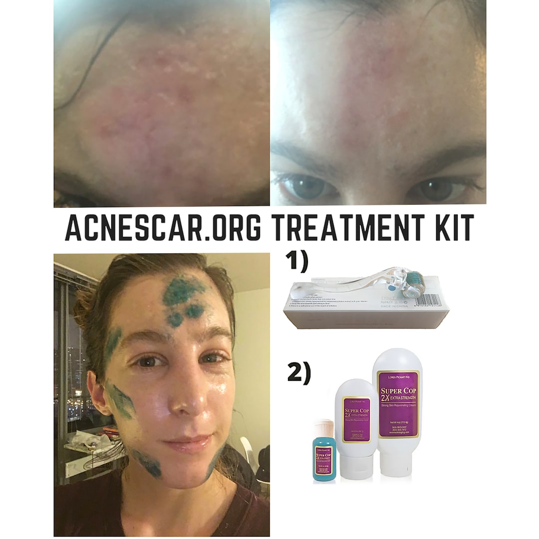 Acne Scars Indented Atrophic Rolling Pitted Deep, Heal Remove Treat Get Rid of Acne Scars Acne