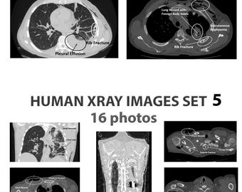 Röntgenbilder, utskrivbara affischer med röntgen, vintage stridstrauma! Digital nedladdning av röntgen, medicinskt collage, present till läkarstudenter, set 5