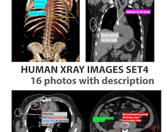X-Ray Images, Posters Xray Printable, Vintage Combat Trauma! X Ray Digital Download,  Medical Collage, Gift for Medical Students, Set 4