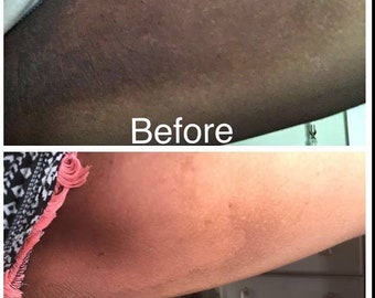 inner thigh bleaching