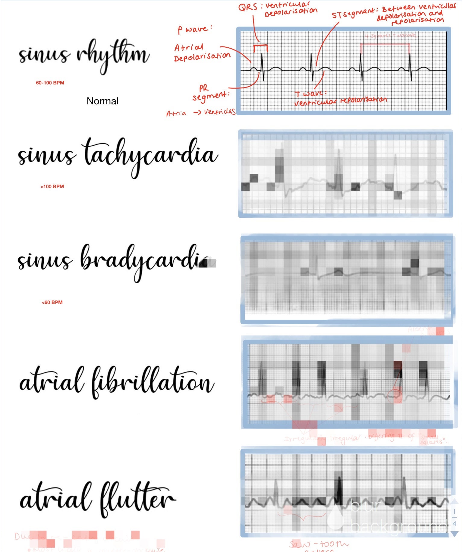 Printable 12 Lead Ekg Interpretation Cheat Sheet 2023 Calendar Printable