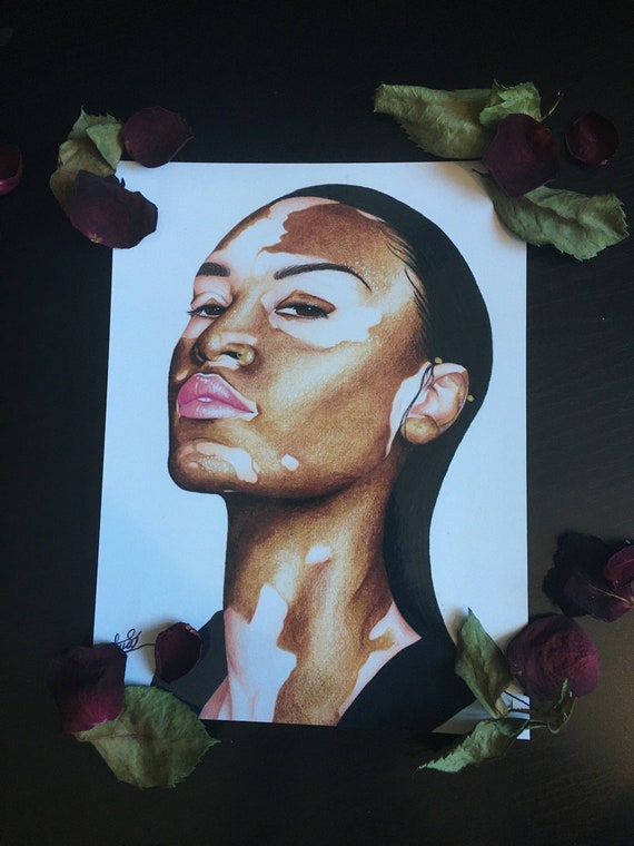 Vitiligo Beauty Art Print Female portrait Art Print Etsy