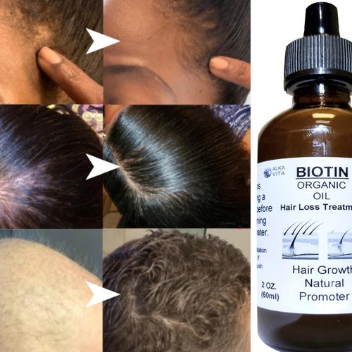 Biotin Hair Loss Growth Promoter Organic Oil & Silica Infused - Etsy UK Biotin Hair Loss Growth Promoter Organic Oil & Silica Infused - Etsy UK