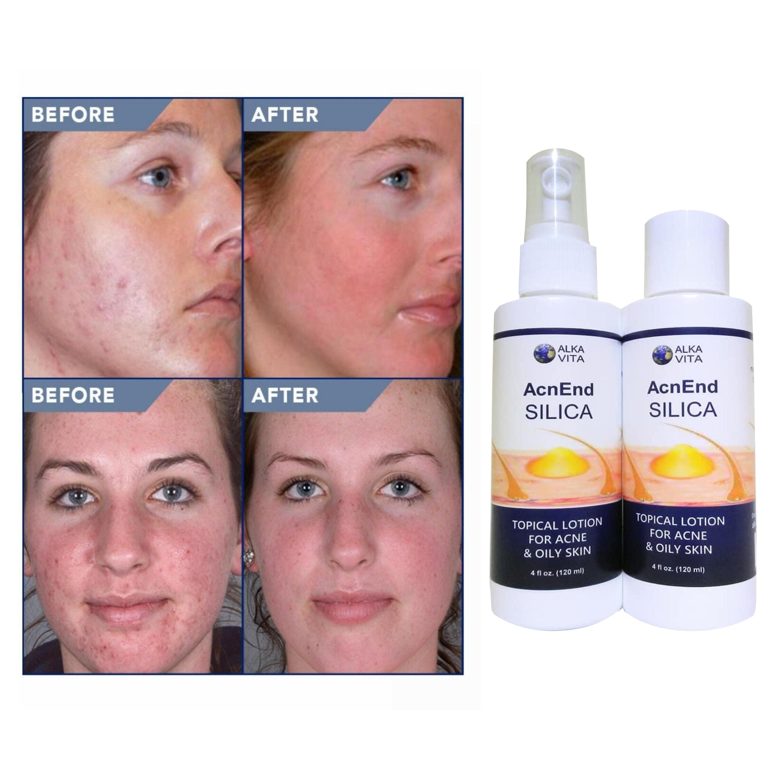 Acne Skin Silica AcnEnd Treatment Topical Gel and Spray Etsy
