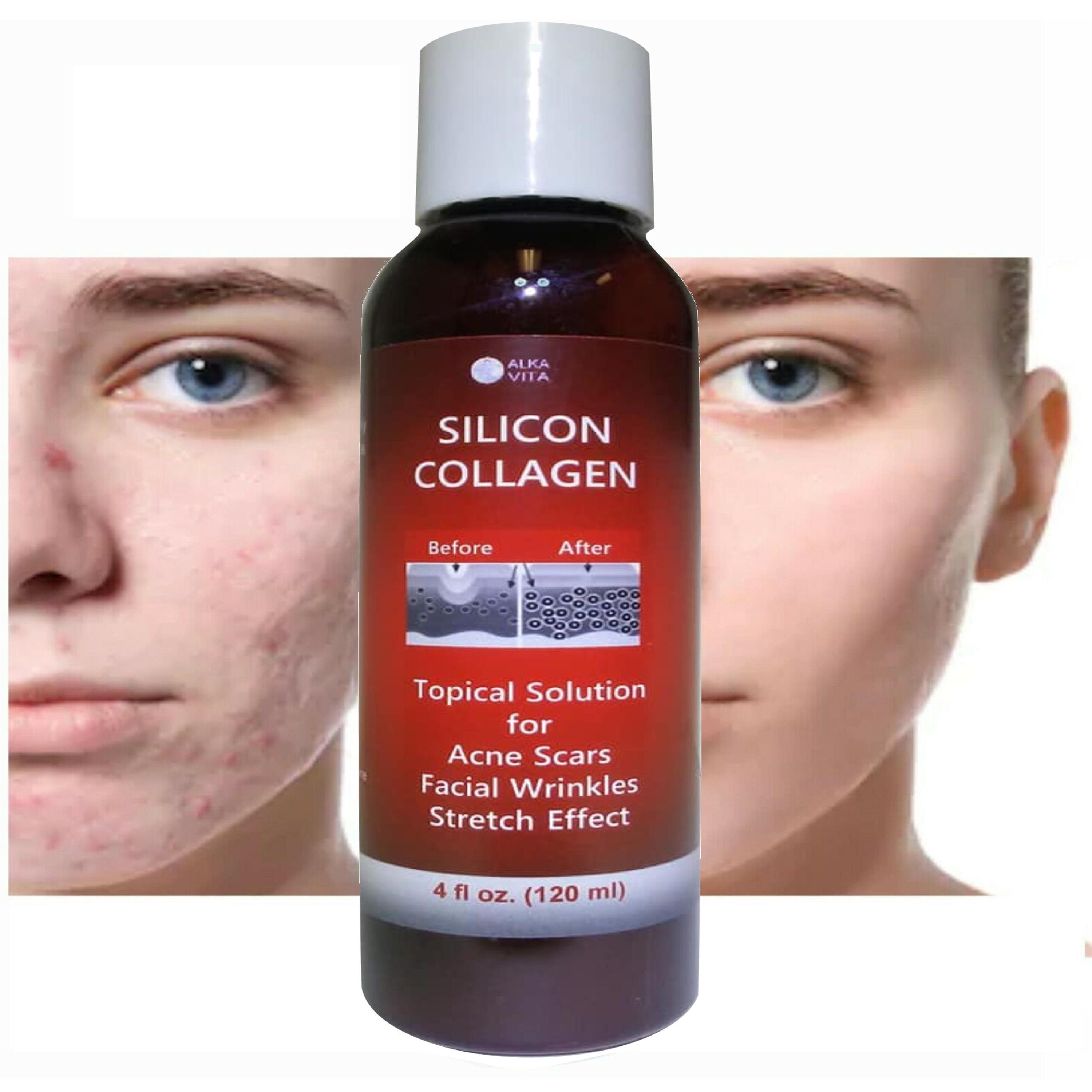 Acne Scars Skin Face Silicon & Collagen Hydrolyzed Gel With Etsy