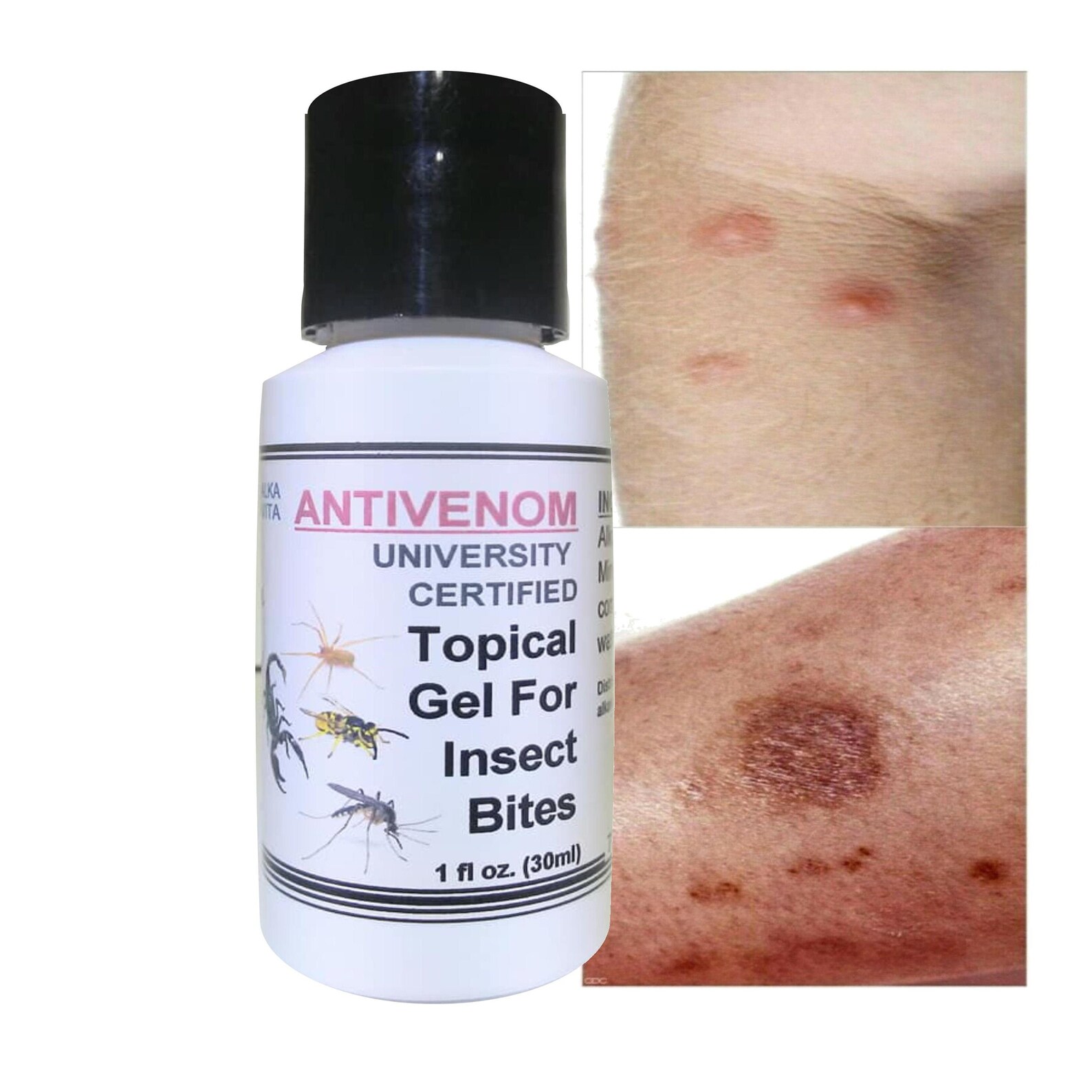 Insect Bites Silica Anti Venom Topical Gel Treatment For Etsy