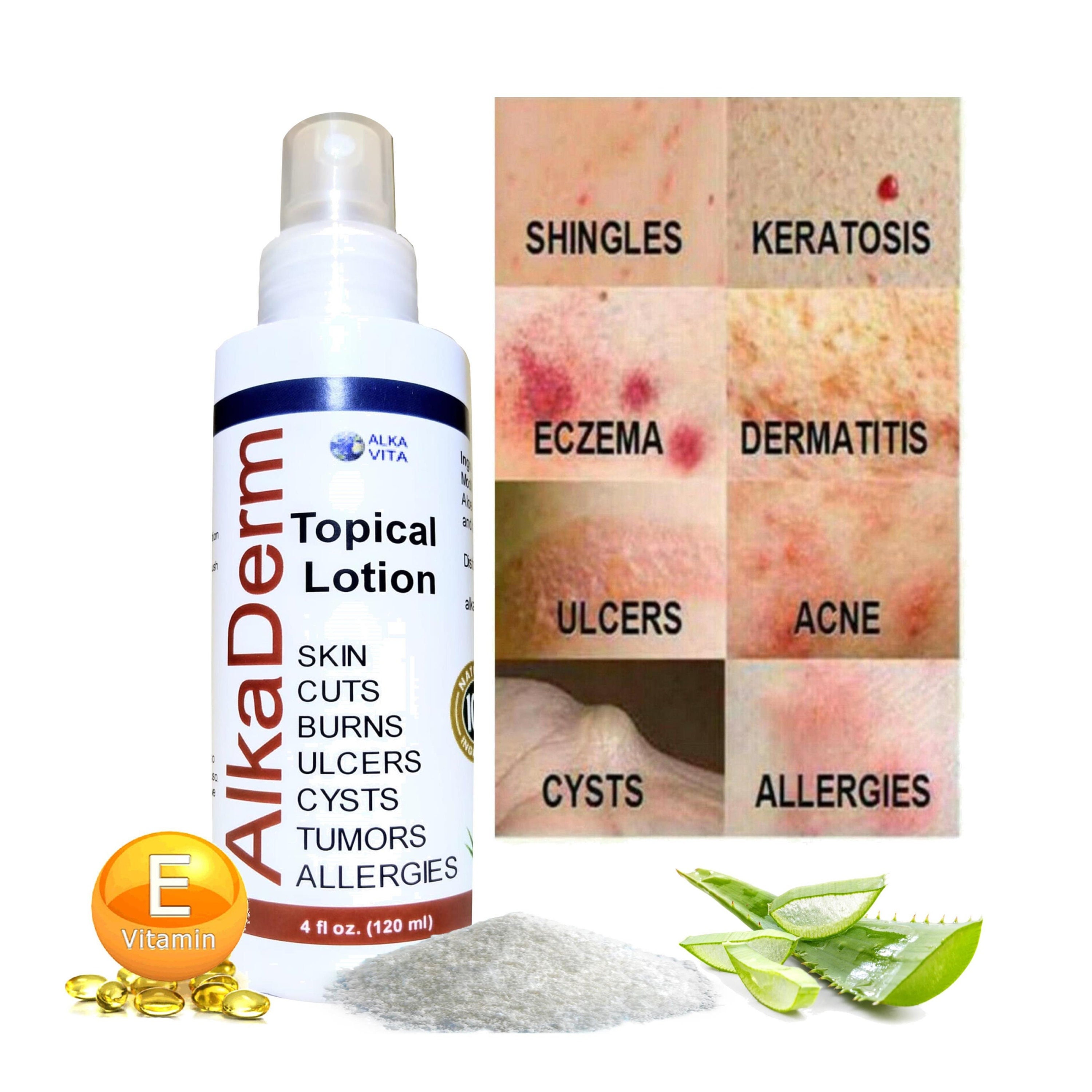 Dermatitis Rosacea Shingles Eczema Psoriasis Burns Alkaderm Etsy