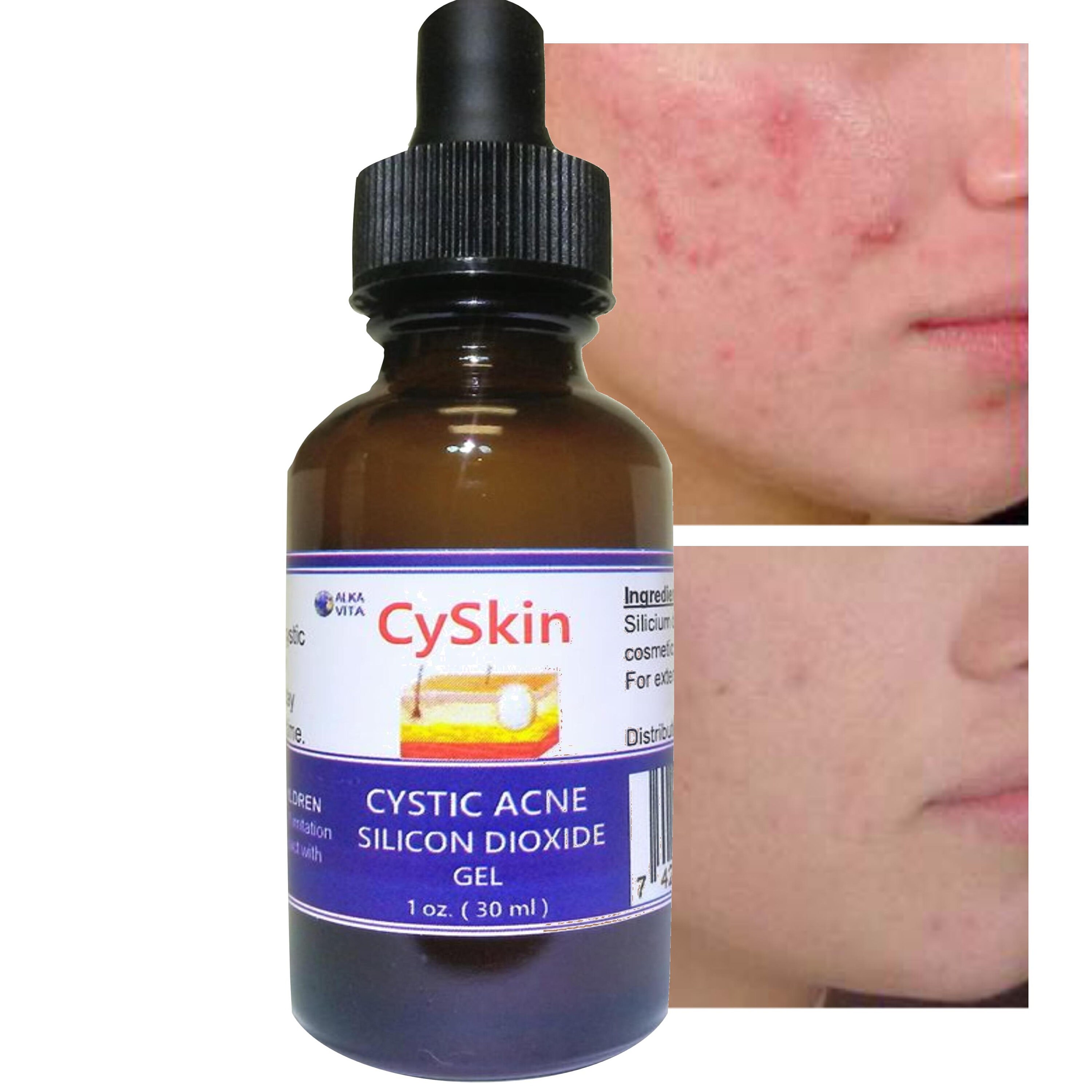 Cystic Acne Skin Treatment Cyskin Silicon Dioxide