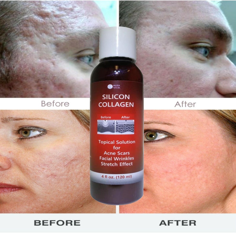 Acne Scars Skin Face Silicon & Collagen Hydrolyzed Gel With Etsy
