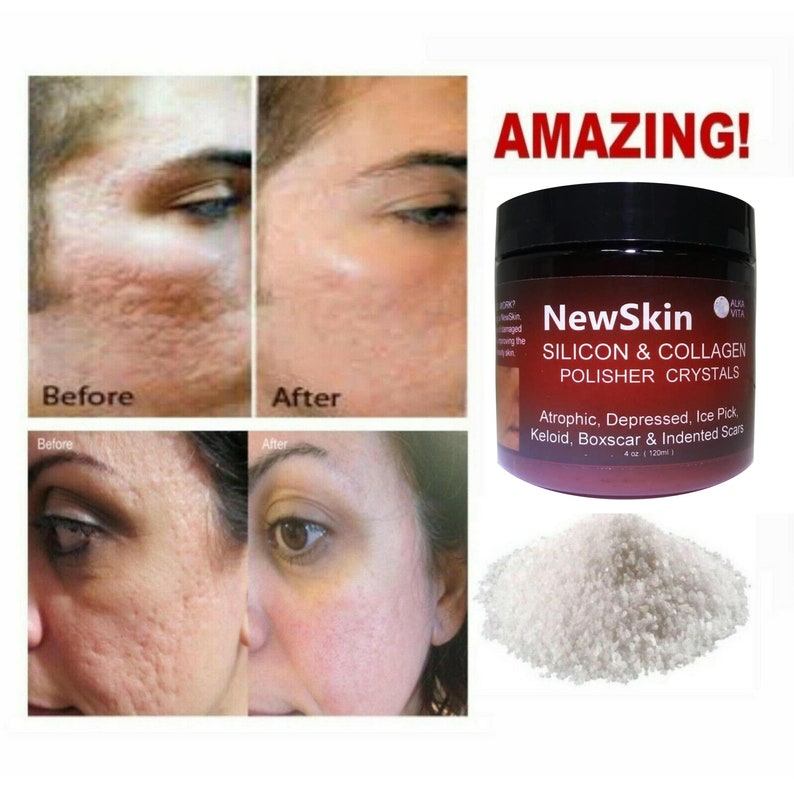 Skin Acne Scars Indented Atrophic Rolling Pitted NEW SKIN Etsy