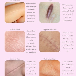 May include: Informative graphic detailing scar types and their suitability for paramedical tattooing. Includes images and descriptions of flat white scars, keloids, stretch marks, hypertrophic scars, concave scars, and contracture scars. Text includes treatment options.