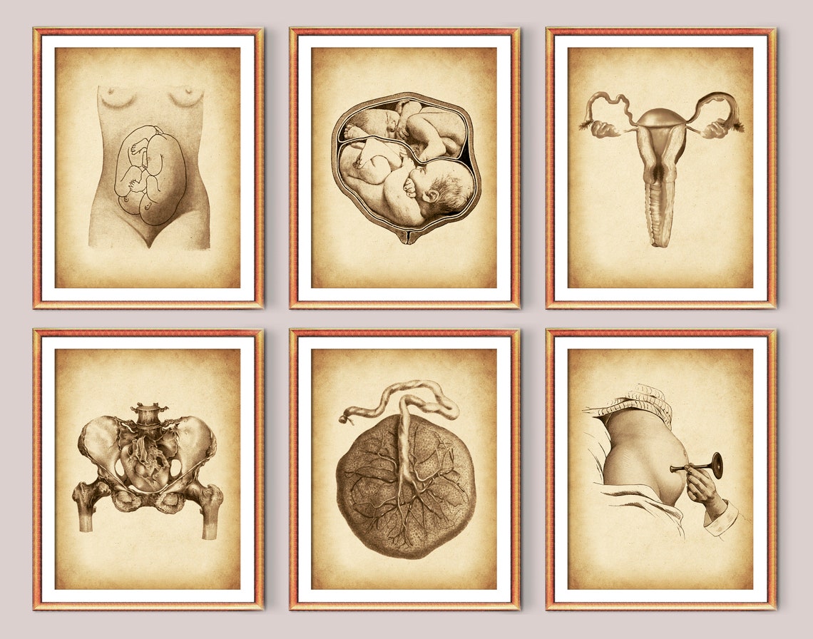 6 Vintage Obgyn Art, Twin Pregnancy Art, Midwife Gift ,twins Fetal ...