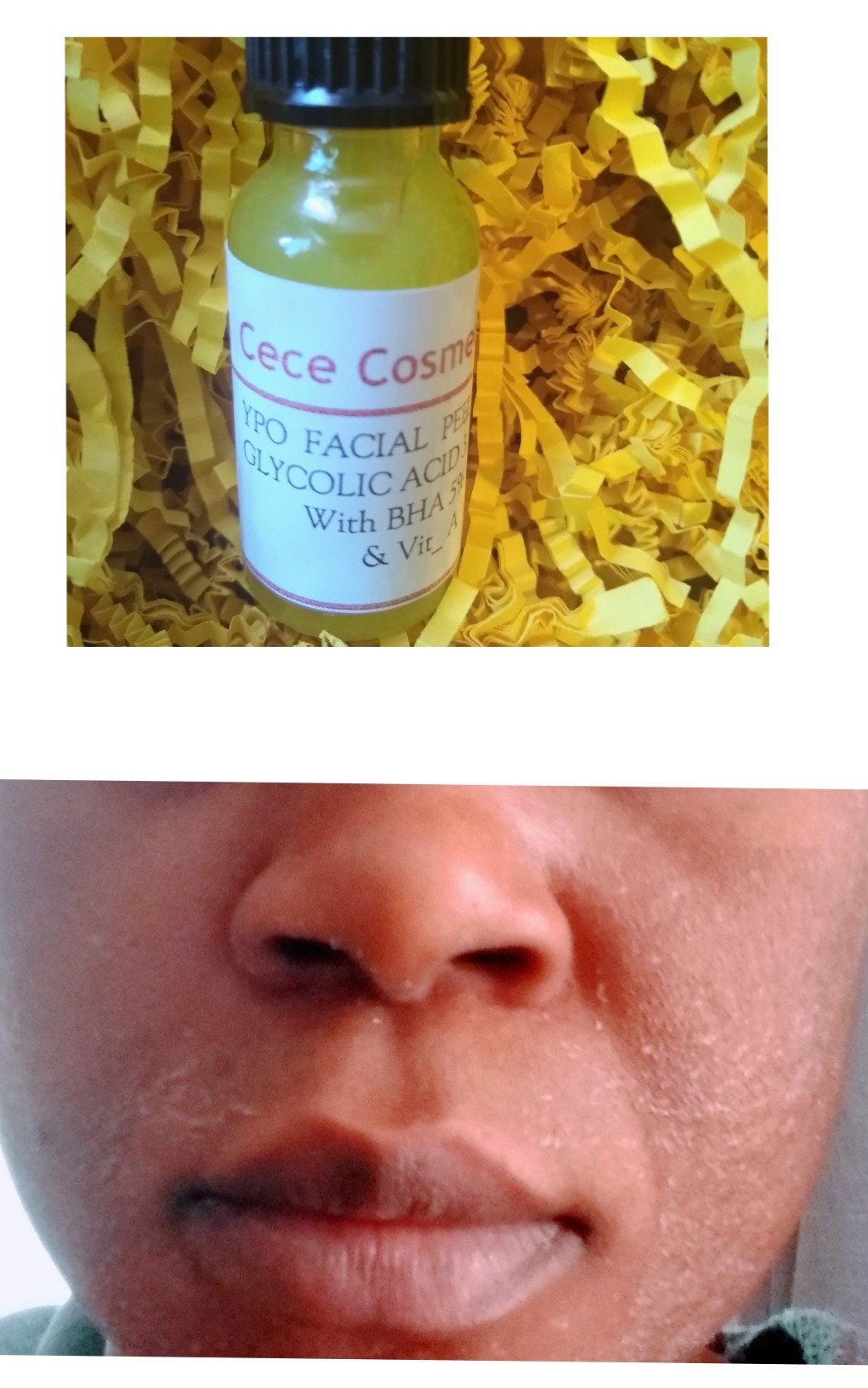 YPO  FACIAL PEEL Oil