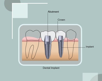 DentalImplant svg, teeth, tooth svg, dental svg, dental png, Dentalschool, Dentalstudent, Dental bundle, DentistryIllustration svg
