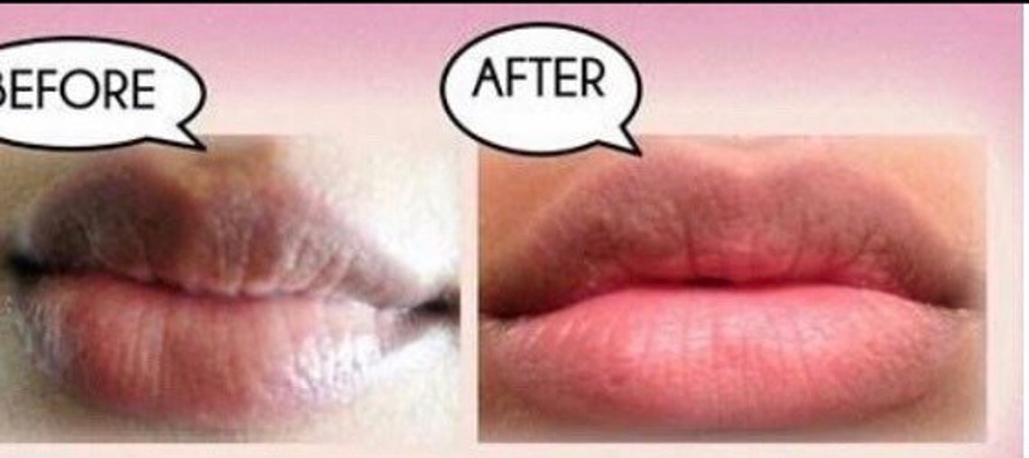 Fast Actives pink lips lightening potent kojic acid and Etsy