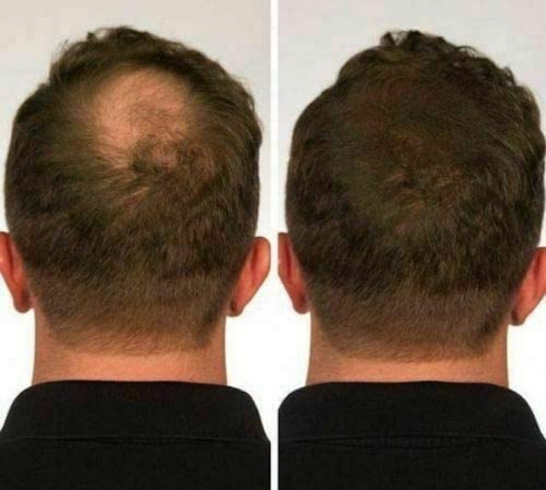 100 Natural Keratin Hair Building Fibres Refill for Hair Loss Solution for Balding Receding