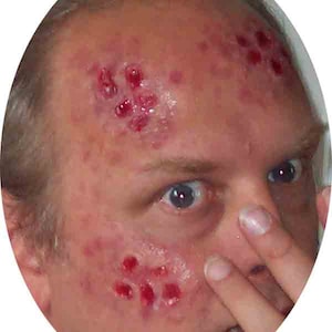 Lesions Aired WaterMelon Appliance Kit (2 lesions)