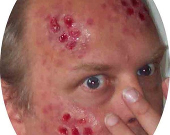 Lesions Aired WaterMelon Appliance Kit (2 lesions)