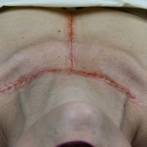 Final Closure Water-Melon Appliance / Appliance Kit (2 stitches)