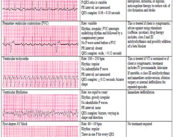 13 cardiac rhythm and dysrhythmias cheat sheet any nurse must know for the exam