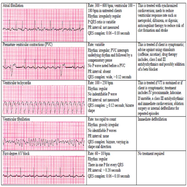 13 cardiac rhythm and dysrhythmias cheat sheet any nurse must know for the exam