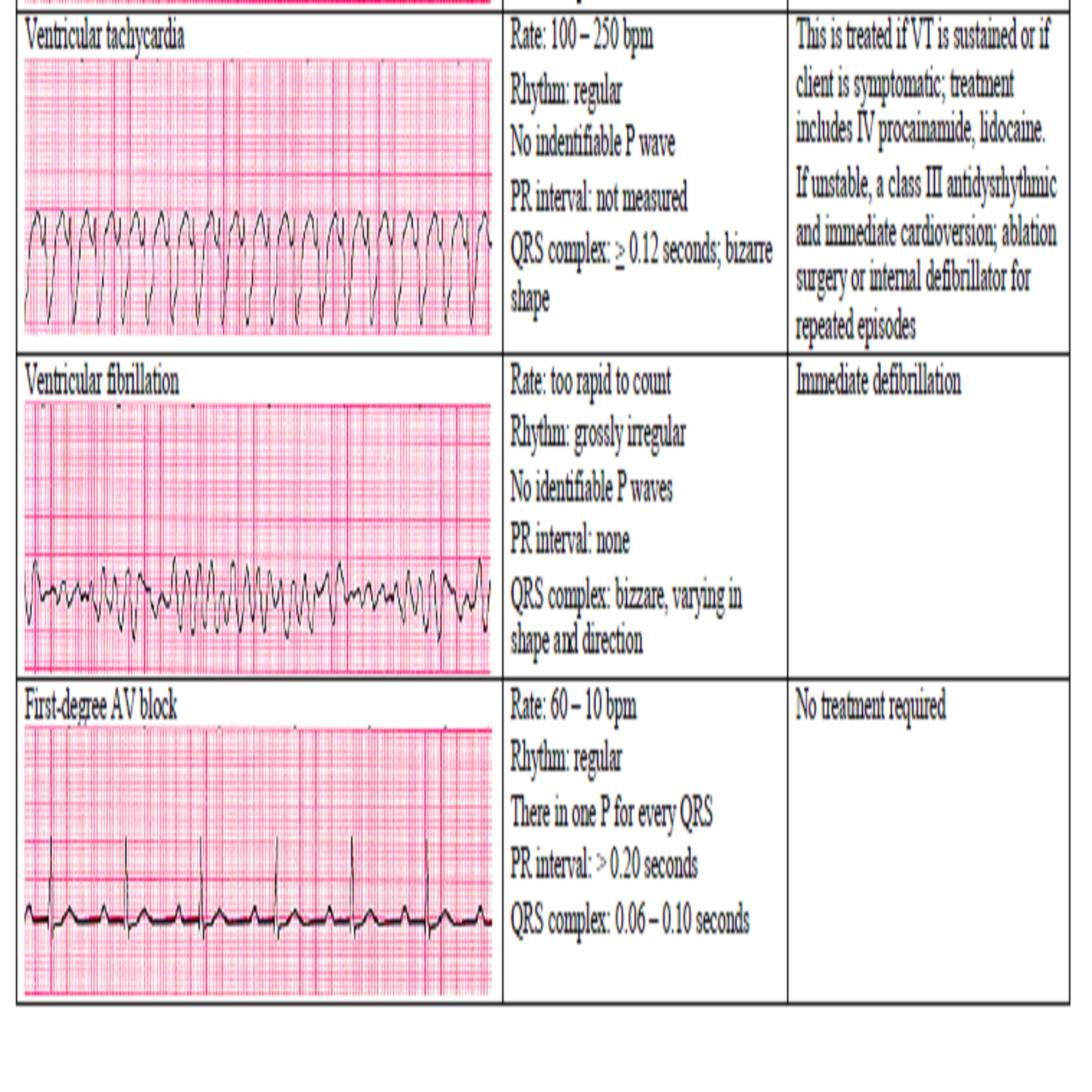 13 Cardiac Rhythm and Dysrhythmias Cheat Sheet Any Nurse Must Know for the Exam Etsy