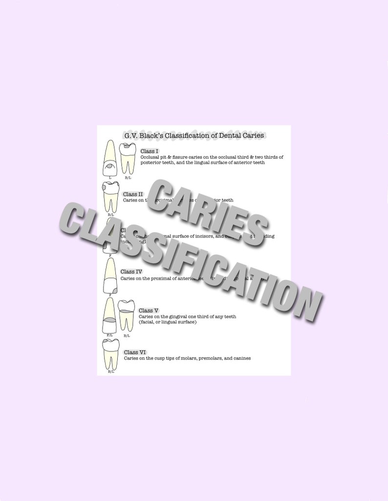 Dental Caries, GV Black, Dentist, Dental Hygiene, Assistant, Hygienist