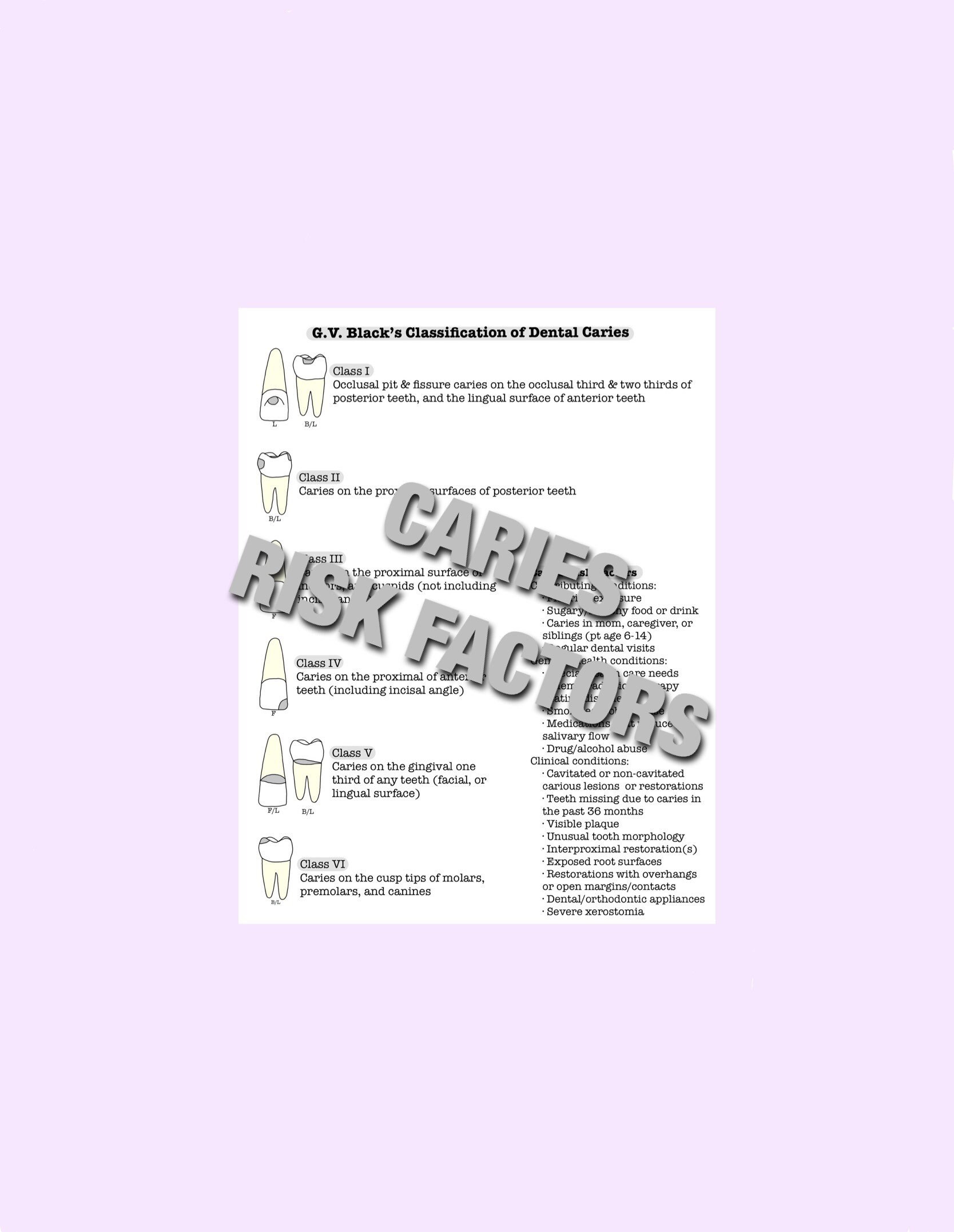 Dental Caries, GV Black, Caries Risk, Dental Hygiene, Hygienist