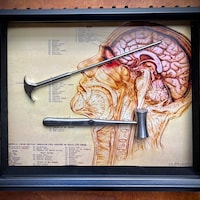 Lobotomy Orbitoclast & Hammer Surgical Medical Tools Shadowbox With ...