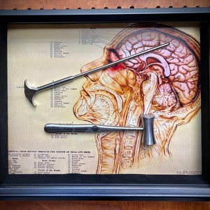 BESTSELLER! Lobotomy Shadowbox Display Large