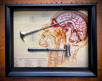 BESTSELLER! Lobotomy Shadowbox Display Large