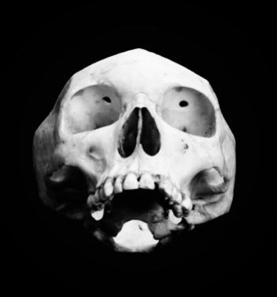 BESTSELLER! Gold Lobotomy Orbitoclast & Hammer Surgical Medical