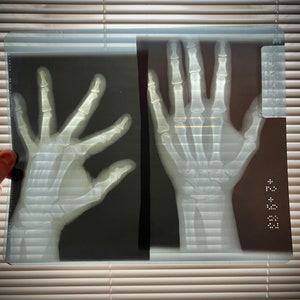 Human Hand Xray X-Ray