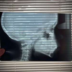 Menschliches Kind Schädel Xray X-Ray