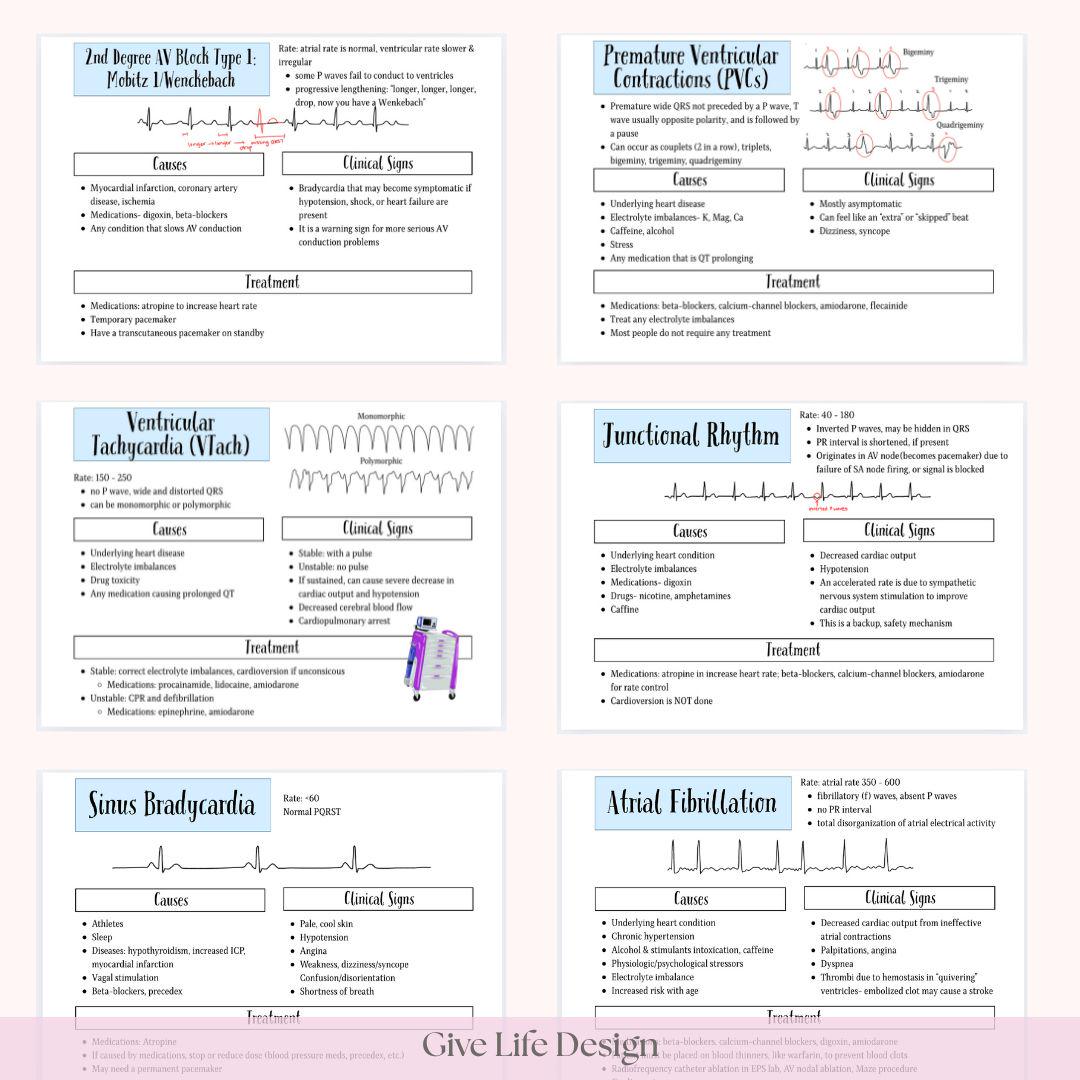 ECG Rhythm Flashcards, EKG Flashcards, Ekg Study Guide, Ecg Study Guide ...