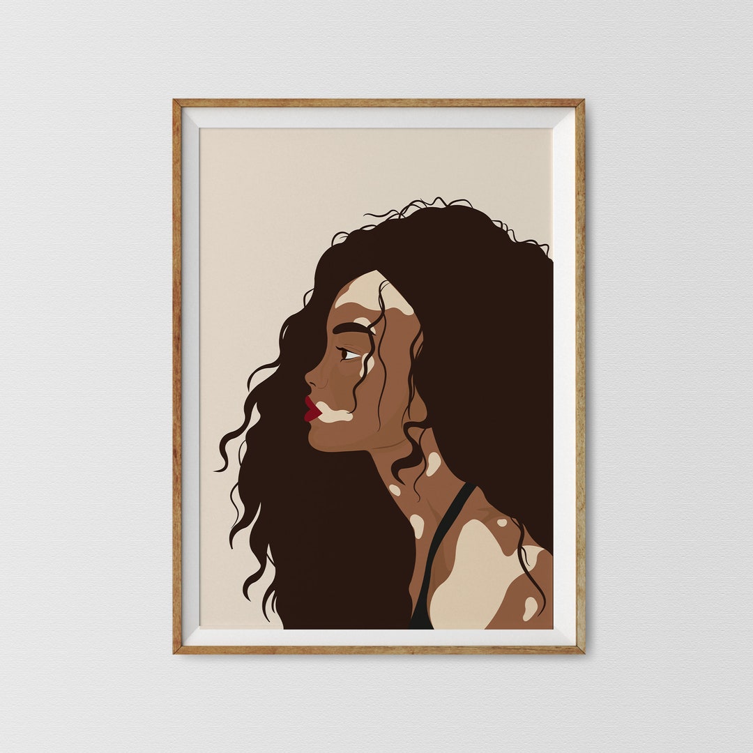 Black Woman Wall Art, Vitiligo Woman Art Print, Vitiligo Print, Body Positivity Art, Awareness