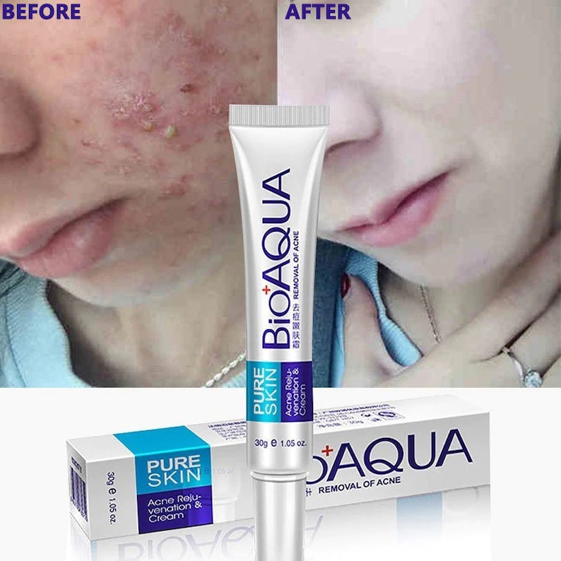 BIOAQUA Acne Scars Blackhead Removal Cream Whitening Acne Etsy