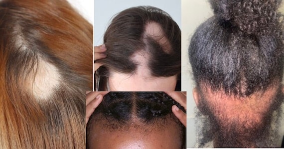 Bald Spot Cover up HD Hair Pieces Covers Bald Spots and Etsy UK