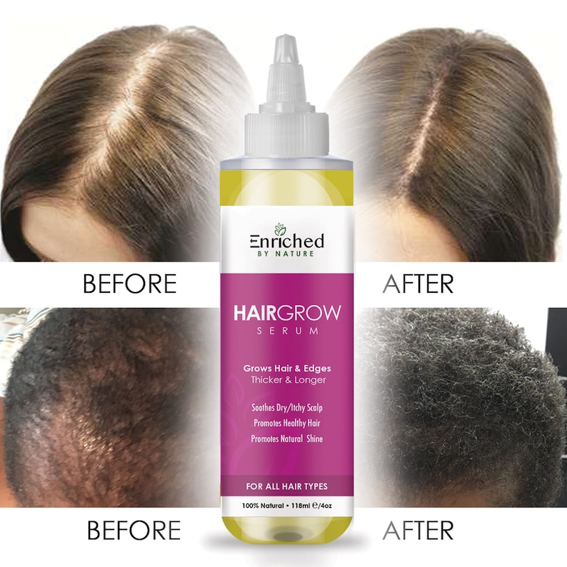 Hair Growth Serum Thinning Hair Edges Hair Treatment Etsy