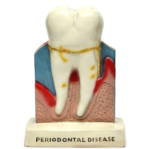 May include: A model of a tooth with visible signs of periodontal disease. The tooth is white with yellowing around the gumline and red inflammation. The base reads "PERIODONTAL DISEASE".