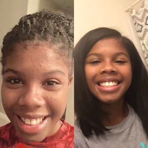 GLOW UP bundle. All-natural ACNE bundle. Adult and teen acne.
