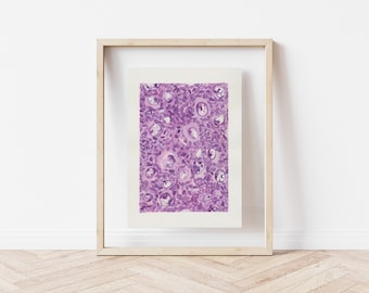 Pathology Art Print: Nodular Lymphocyte-predominant Hodgkin Lymphoma, Cancer I