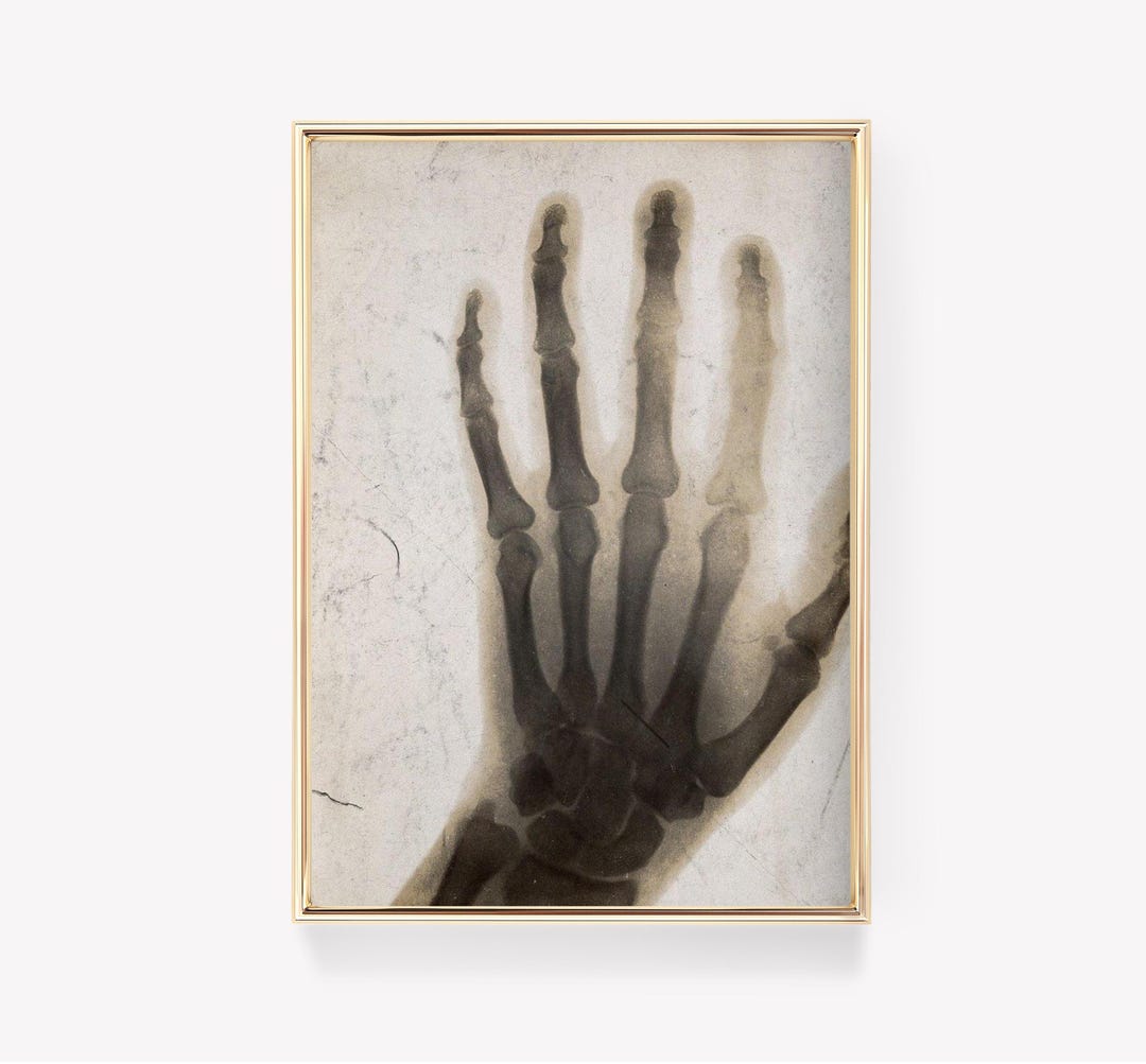 Wilhelm Röntgen X-ray | Vintage Poster | Anna Bertha's Hand | Medical ...