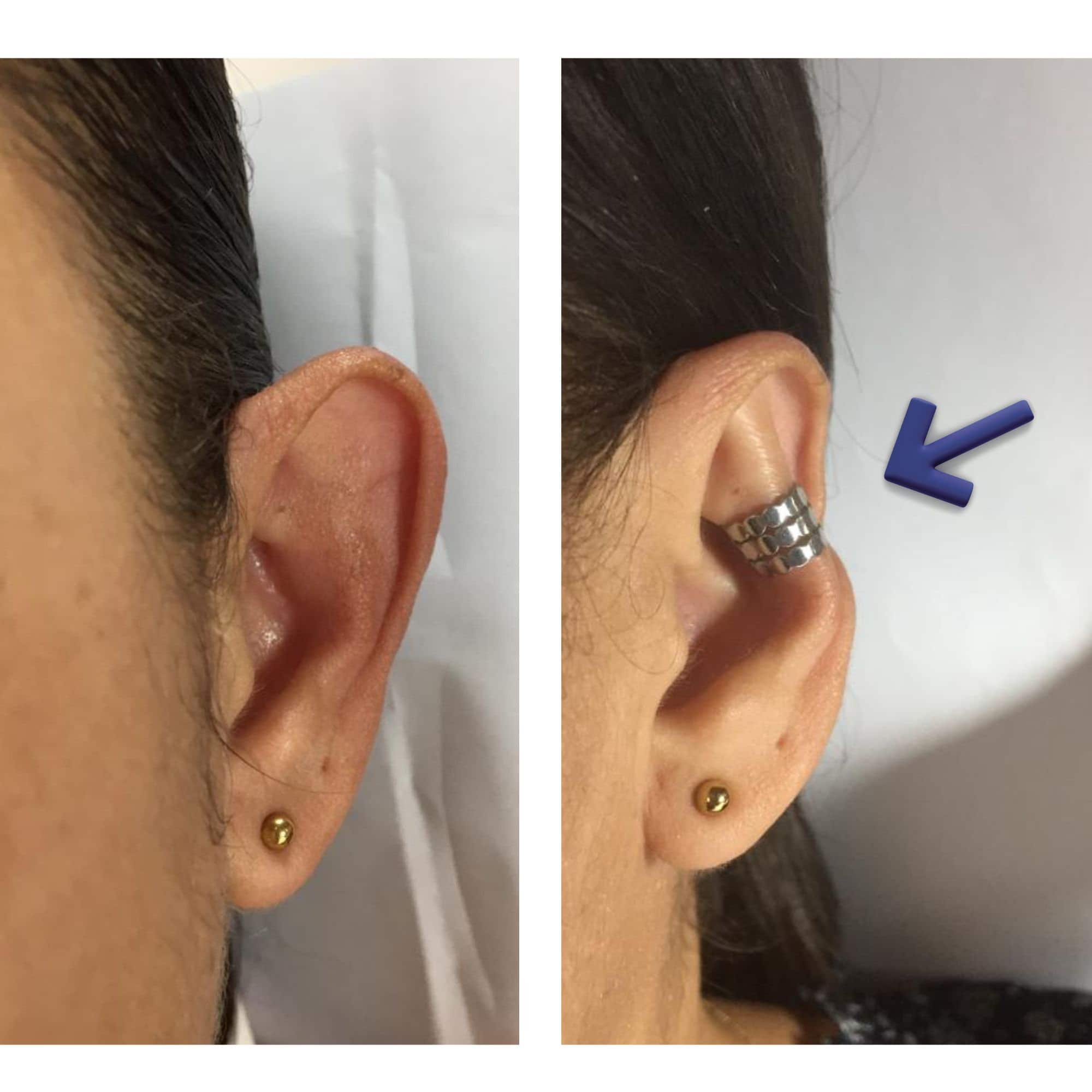 Magic Earring Lifters, Ear Lobe Supports, PAIR 